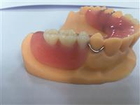 Digital-3D-Print-Acrylic denture